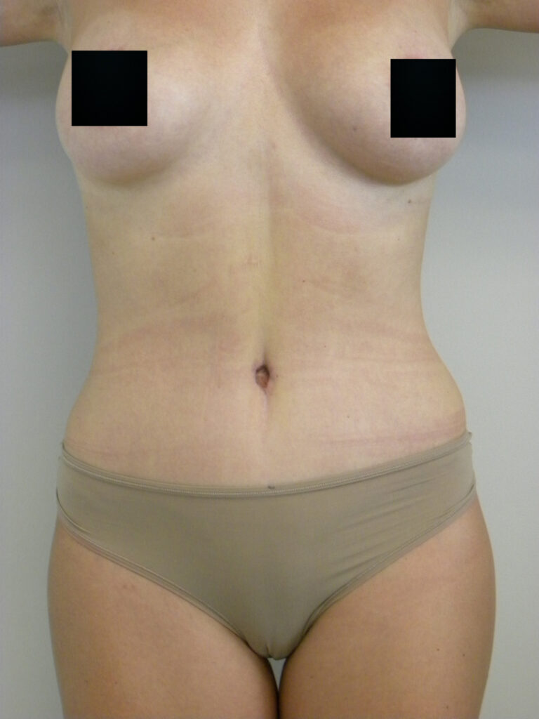 Plastic Surgery Before and After Pictures in Miami, FL - Dr. Adam J. Rubinstein 